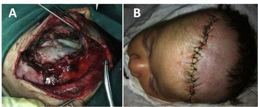 Intraoperative photographs showing watertight dural closure with graft (A) and wound closure (B).