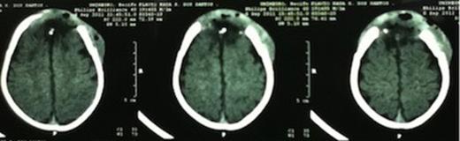 Postoperative brain CT scan