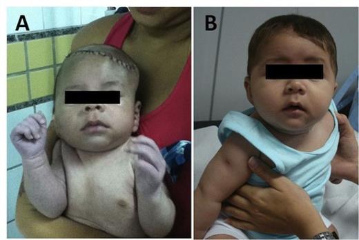 Postoperative photograph obtained seven days (A) and six months (B) after surgery