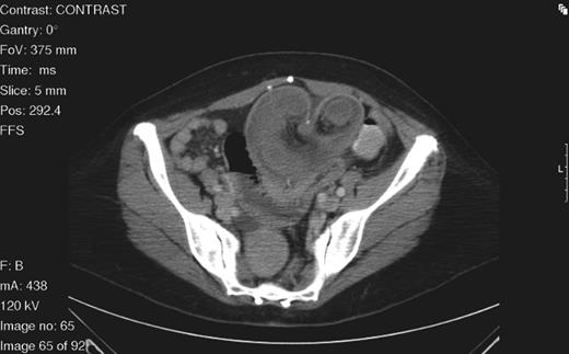 Axial abdominal CT scan demonstrating a target sign mass consistent with intussusception with its inferior aspect tapering to a point consistent with volvulus.