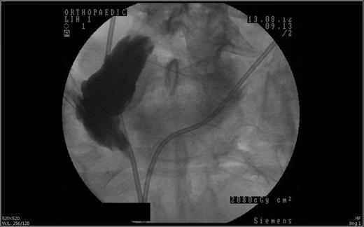 Loopogram revealed the stricture at 4 cm proximal to the skin opening of the conduit.