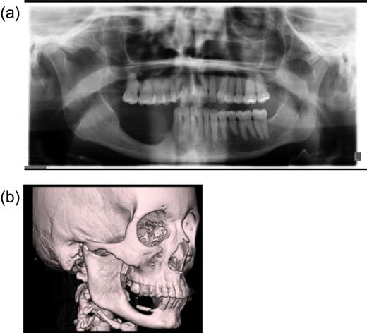 Imaging of the patient's mandibular defect pre-surgically. (a) Radiolocal image of patient's jaw. (b) CT scan of head