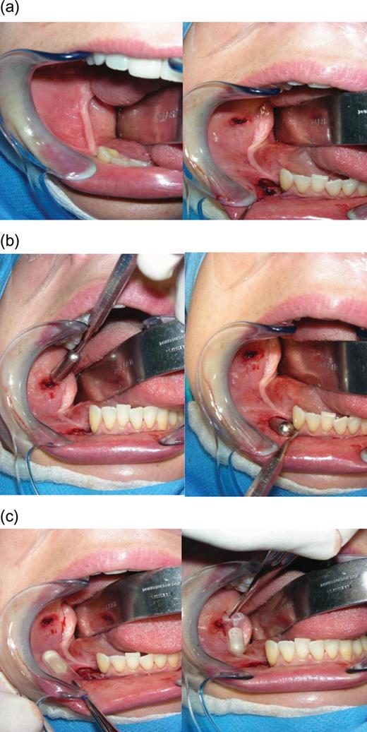 Image of patient's oral cavity during insertion of Osmed pellets. (a) Incisions made in the submucosa. (b) Guides used to size the tunnel for the Osmed pellets. (c) Osmed pellets before insertion into the submucosa