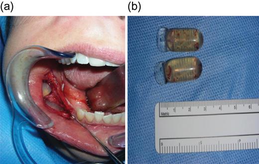 Submucosa after adequate tissue expansion. (a) Opening of submucosa to reveal Osmed pellets. (b) Size of Osmed pellets