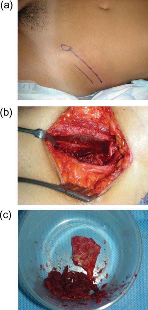 Autogenous iliac bone grafting. (a) Marking of bone graft incision site. (b) Open site where iliac bone graft is harvested from (c) cortical and cancellous iliac bone