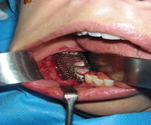 Titanium construct packed with iliac bone graft and screwed into position on the lower mandible