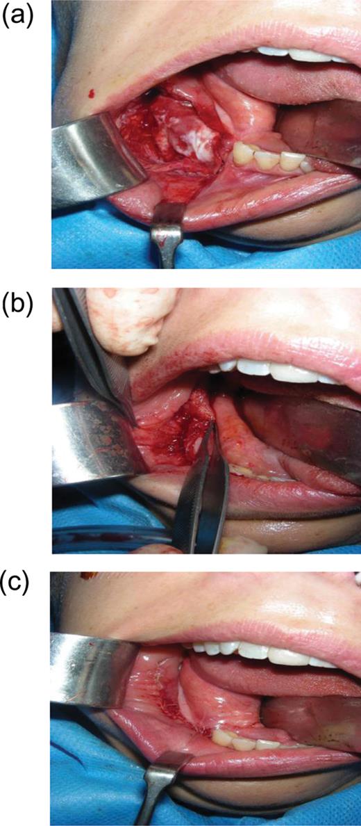 Image of patient's surgical site. (a) Tissue expanded submucosa is sutured close. (b) Buccal mucosa is sutured close. (c) Image of post-surgical site