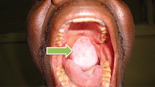 Oropharyngeal mass pre-operative.