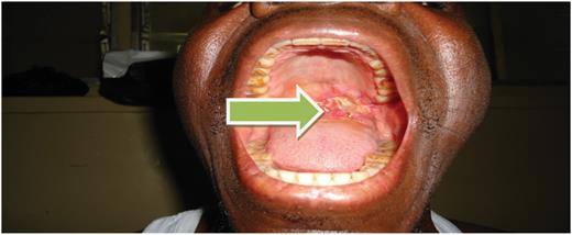 Five post-operative day.