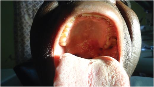 Two weeks post-operative.