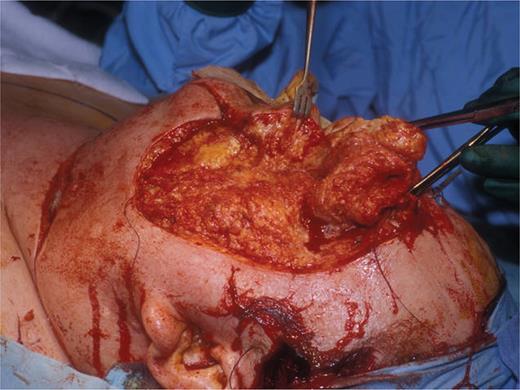 Peri-operative view of initial resection (published with the patient's consent).
