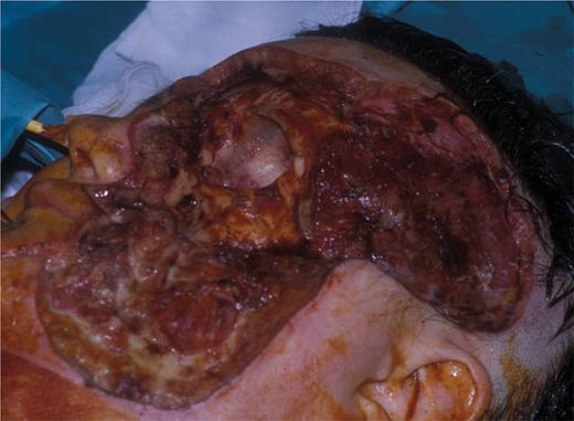 Immediate post-operative view of secondary resection (published with the patient's consent).