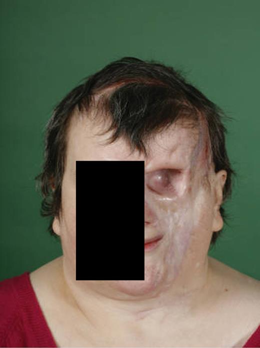 Eighteen months after resection (published with the patient's consent).