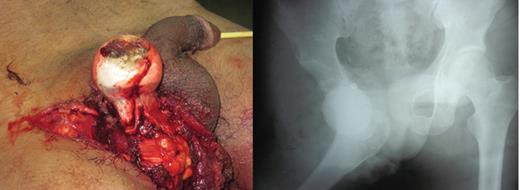 Figure and radiograph showing an open anterior hip dislocation.