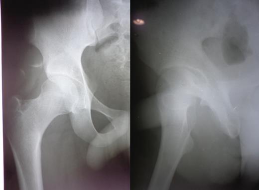 Immediate post-operative radiograph showing the reduction.