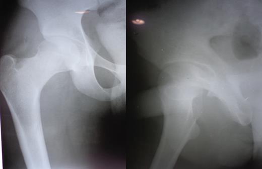 Plain radiographs at 6 months showing the reduction.