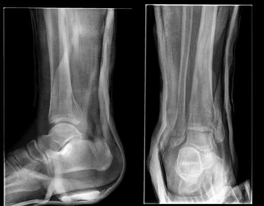 AP and lateral radiographs of the fracture post-reduction and immobilization.