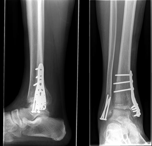 AP and lateral radiographs of the fracture post-fixation.