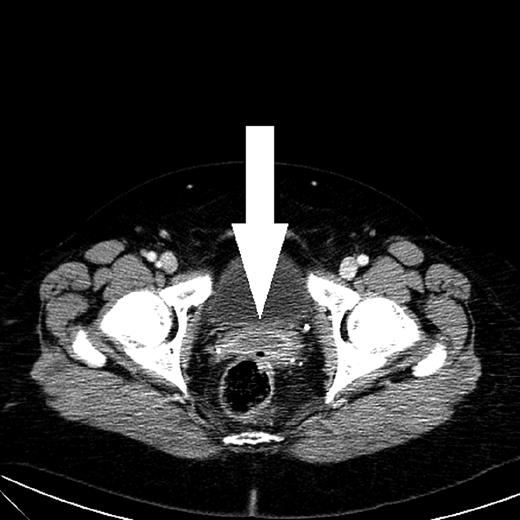 CT scan shows an abscess with peripheral rim enhancement in the Douglas pouch.