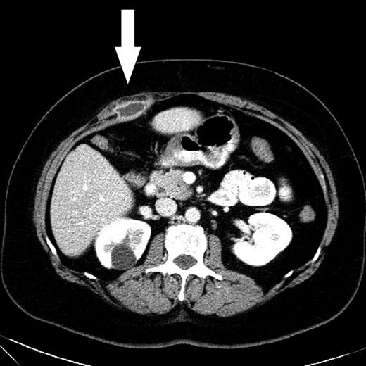 CT scan shows an abscess with peripheral rim enhancement beneath the right rectus abdominis muscle. A simple cyst of the right kidney was a coincidental finding.