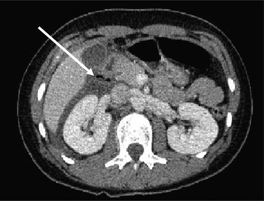CT of abdomen showing free air in right para-renal space (white arrow).