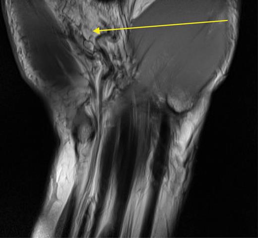 T1-weighted MRI scan of Guyon's canal. The arrow indicates the fatty mass reported as lying atop Guyon's canal.