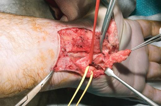 Operative pictures of Guyon's canal: lipoma in forceps, yellow sloop around nerve, red sloop around the ulnar artery.