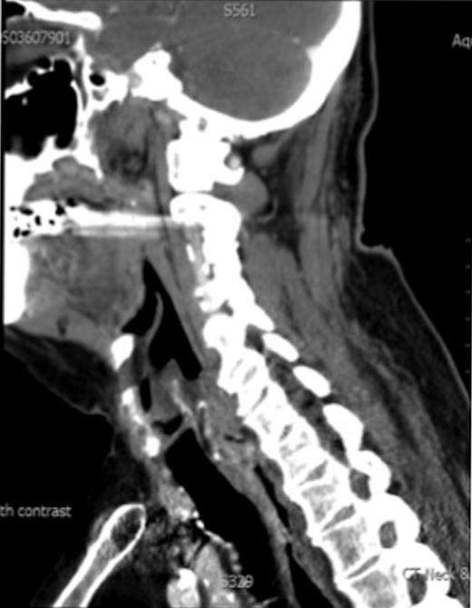 CT scan showing the post cricoid carcinoma extending down to upper oesophagus.