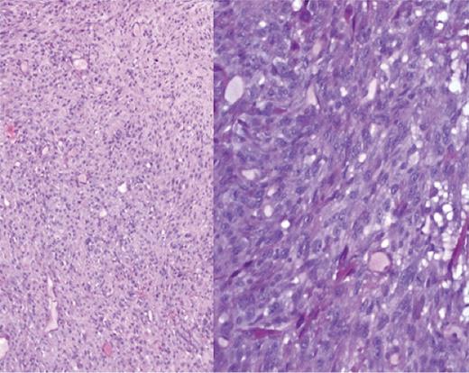 Ă—5 and Ă—10 magnification shows a cellular tumour with short to elongated cells with scant intervening stroma.