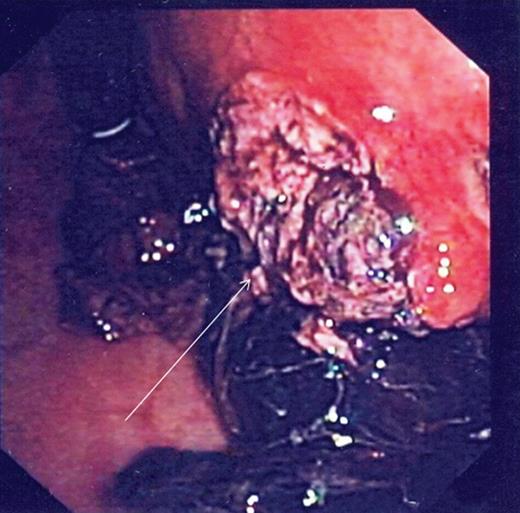 Endoscopy showing ulcer crater in greater curvature of stomach.