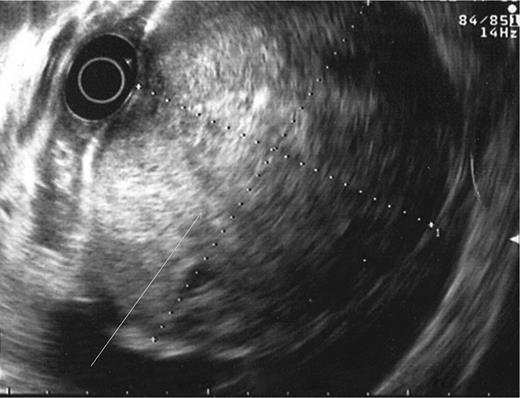 Endoscopic ultrasound showing lesion abutting stomach wall extending into peritoneal cavity.