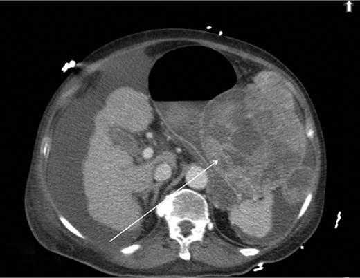 Computed tomography image showing HCC invading into greater curvature of stomach.