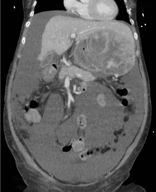 Computed tomography image showing tumour originating from the liver.