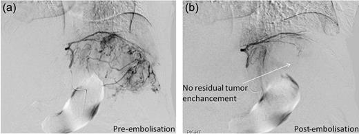 Pre- and post-trans-arterial embolization images of HCC leading to successful haemostasis.
