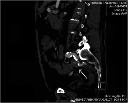 CT angiogram: a saggital view showing pseudoaneurysm of the left internal iliac artery (white arrow).