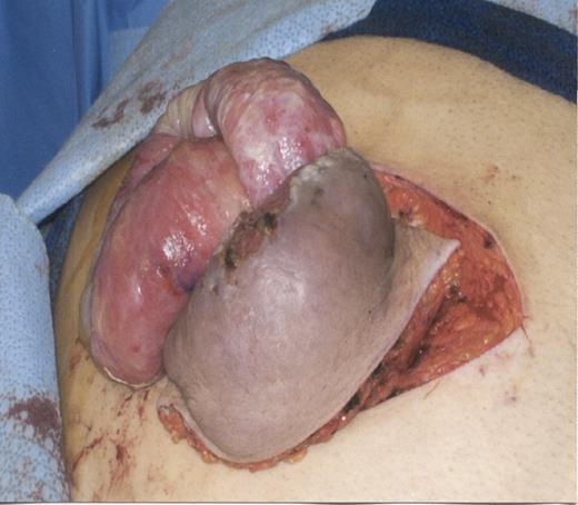 Eviscerated small bowel through an umbilical hernia in a cirrhotic patient.