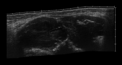 Ultrasound image showing heterogenous mass between the two heads of gastrocnemius muscle.