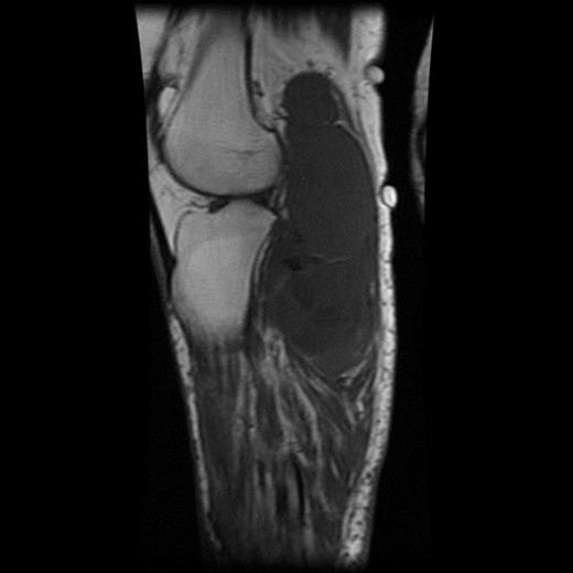 T1-weighted MRI image showing mass occupying whole of posterior aspect of knee extending to proximal portion of the leg.