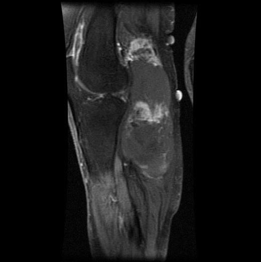 T2-weighted MRI image of the same mass lesion.