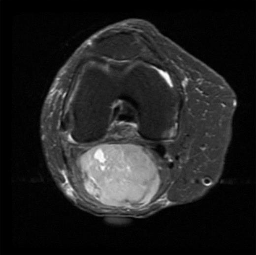 Axial MRI image of sarcoma.