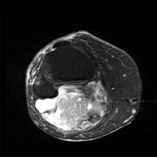 Post gadolinium-enhanced MRI image showing circumferential lesion.