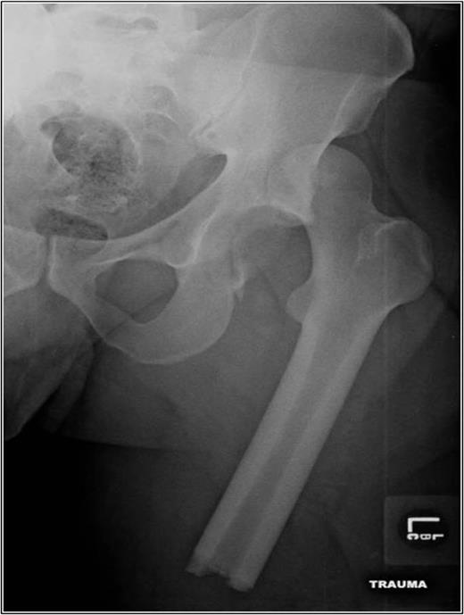 AP left hip demonstrating a diaphyseal transverse femur fracture with ipsilateral hip dislocation.