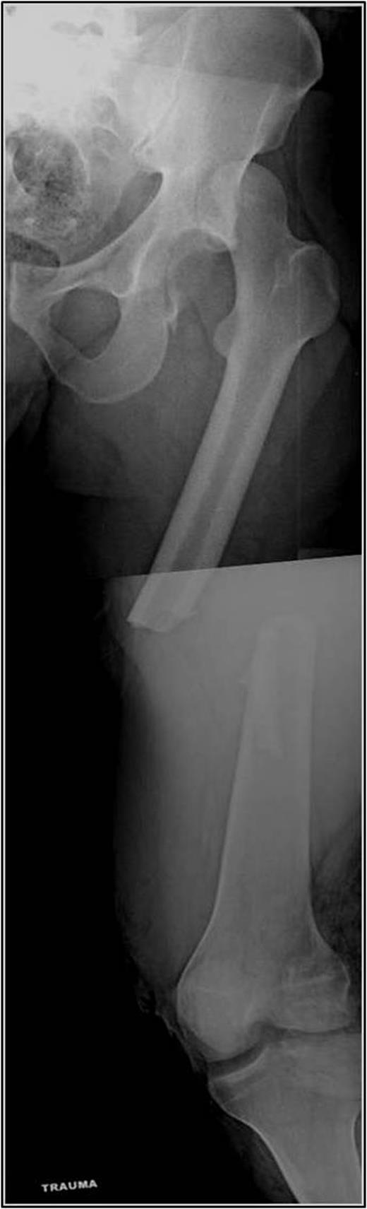 AP left femur of type B floating hip with associated hip dislocation. The medial knee soft tissue injury is also appreciated.