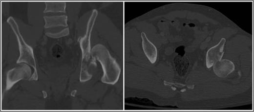 Coronal and axial CT pelvis of the left femoral head engaging with the postero-superior acetabulum.