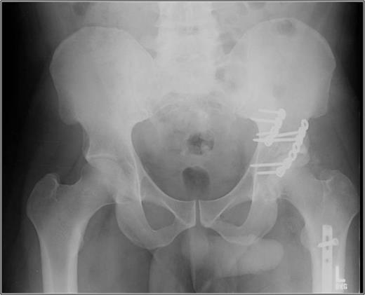 AP pelvis 8 months status post-ORIF of posterior wall with retrograde femoral nail. The left hip demonstrates early post traumatic arthritis and heterotopic ossification.