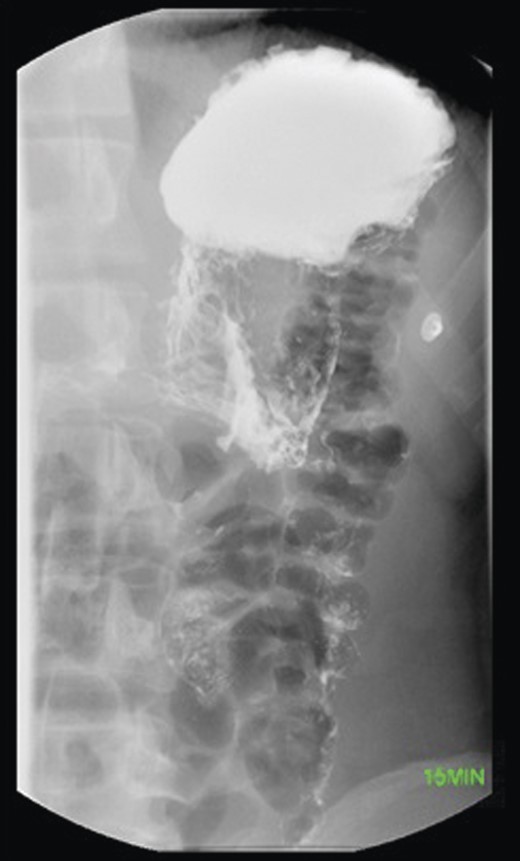 Preoperative UGI contrast study.
