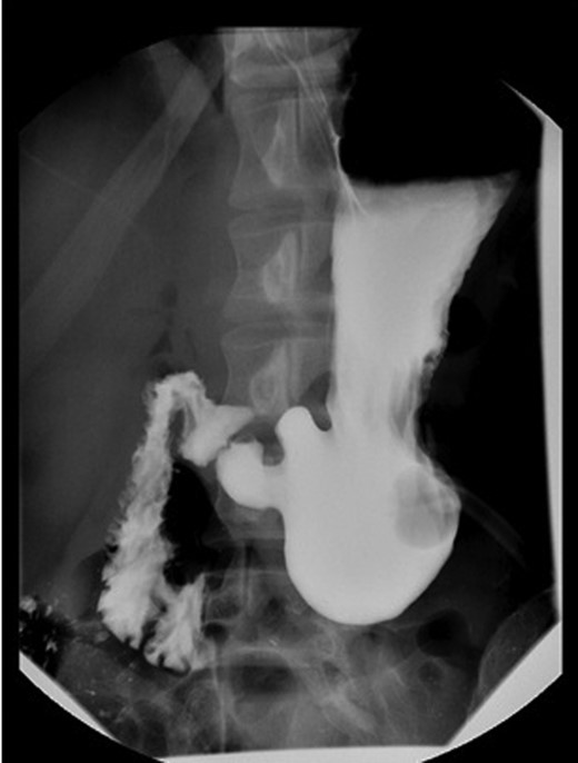 Postoperative UGI contrast study.