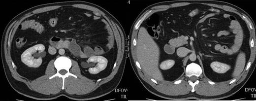 CT scan of the abdomen demonstrating left paraduodenal hernia.