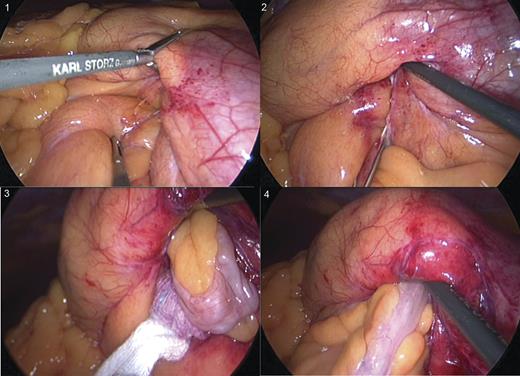 (1–4) Identification and laparoscopic reduction of paraduodenal hernia in the sequence.