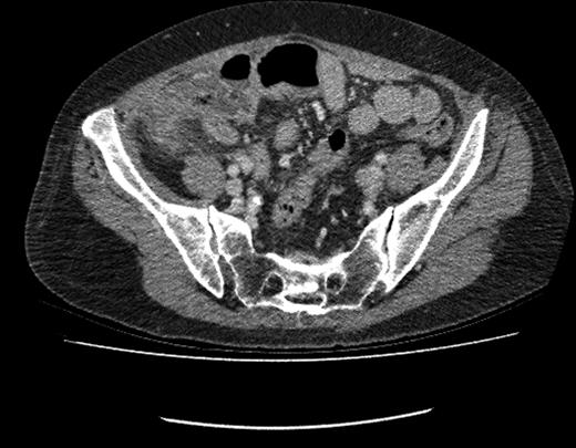 CT image showing fluid-filled appendix with peri-caecal fat stranding.